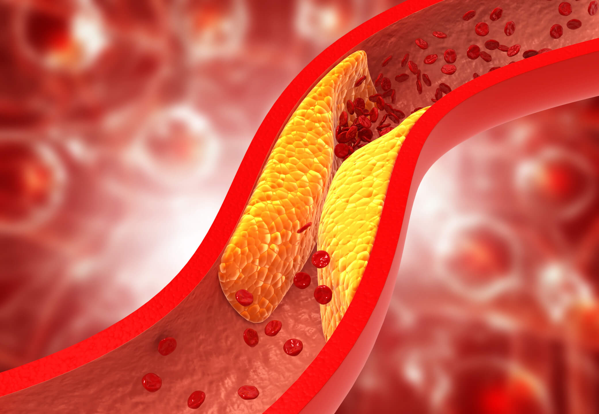 Arteriosclerosi memoria