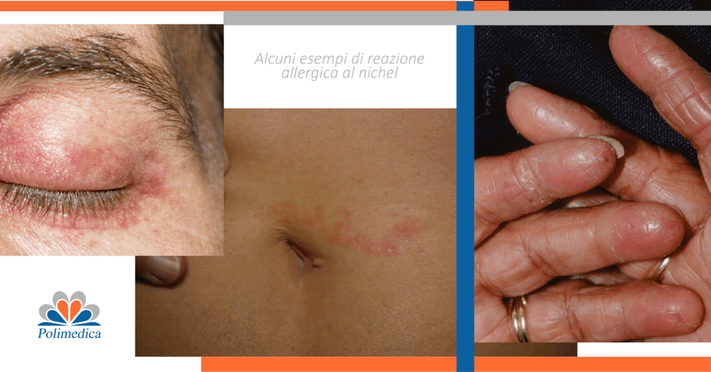 Allergia al nichel sintomi gastrointestinali
