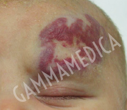 Angioma palpebrale adulto