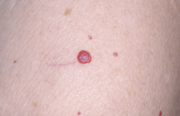 Angioma tuberoso superficiale
