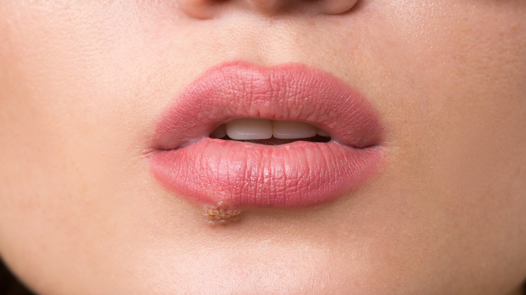 Herpes labiale cause psicologiche