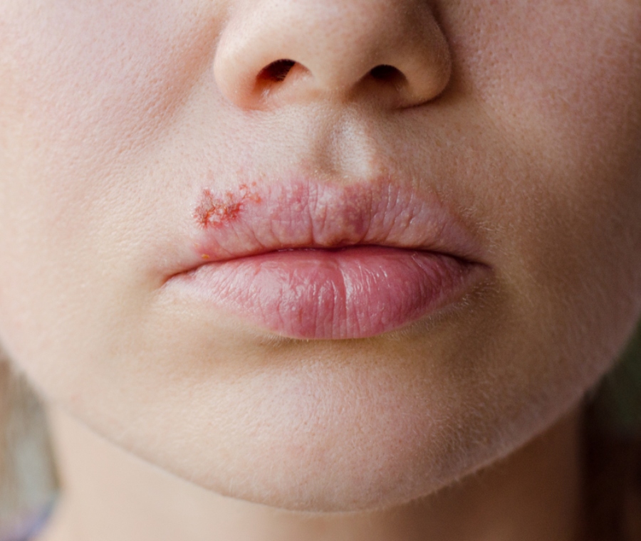 Herpes labiale
