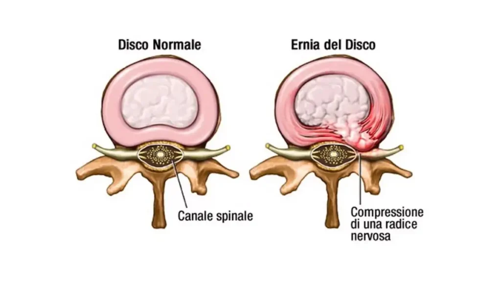 Ernia del disco